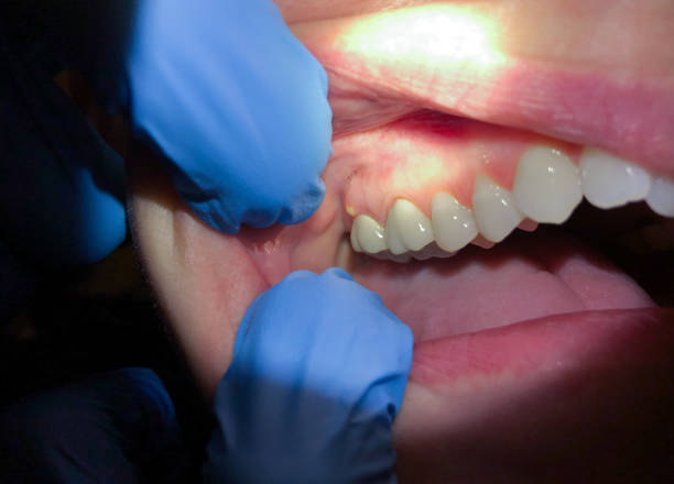 Best Broken Tooth Emergency  in Chelsea, MI